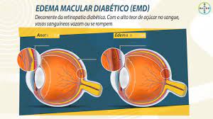 El CHMP recomendó la aprobación en la UE de Vabysmo de Roche, la primera vacuna ocular activa para tratar las dos causas principales de la pérdida de visión